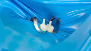 Post-Endodontic Restoration Gains Strategic Focus in Dentistry for Enhanced Longevity and Structural Integrity