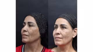 Combined Microneedling-Exosome Protocol Shows Melasma Improvement in Skin of Color