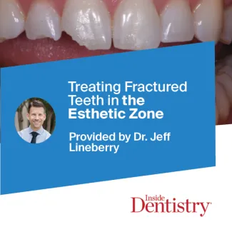 Ecosite Elements Showcased in Inside Dentistry for Breakthrough Esthetic Restoration