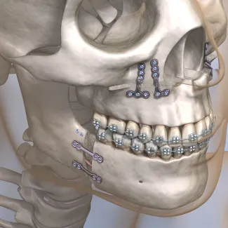 Orthognathic Surgery Re-Emerges as Strategic Solution for Complex Skeletal Malocclusions