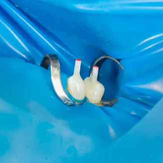 Post-Endodontic Restoration Gains Strategic Focus in Dentistry for Enhanced Longevity and Structural Integrity