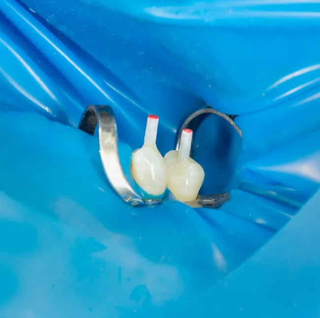 Post-Endodontic Restoration Gains Strategic Focus in Dentistry for Enhanced Longevity and Structural Integrity