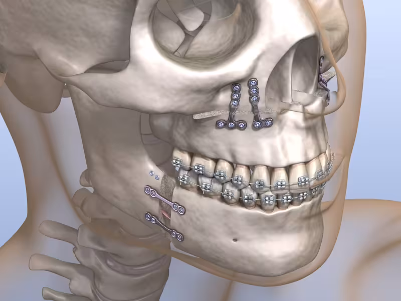 Orthognathic Surgery Re-Emerges as Strategic Solution for Complex Skeletal Malocclusions