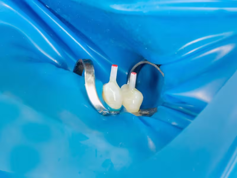 Post-Endodontic Restoration Gains Strategic Focus in Dentistry for Enhanced Longevity and Structural Integrity