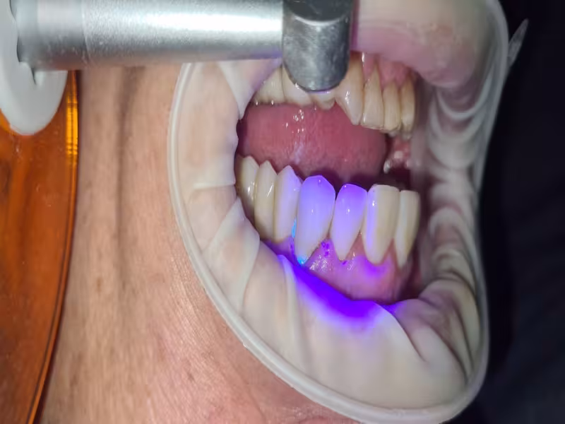 VOCO Launches Fluorescence-on-Demand Portfolio Across Temporary Luting, Core Build-Up, and Aligner Workflows