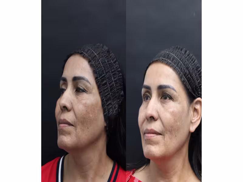 Combined Microneedling-Exosome Protocol Shows Melasma Improvement in Skin of Color